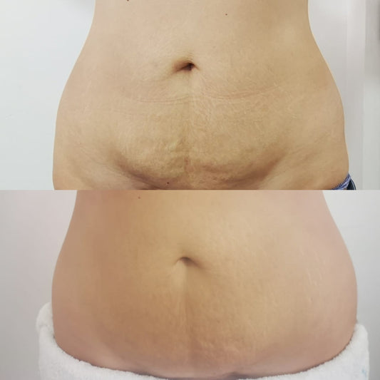 Pack Reafirmante Pro 8S - Criofrecuencia + Carboxiterapia.