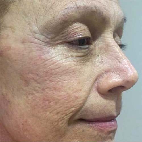 1 sesión PB serum + criofrecuencia