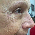 Pack de 6 sesiones Criofrecuencia mejillas facial