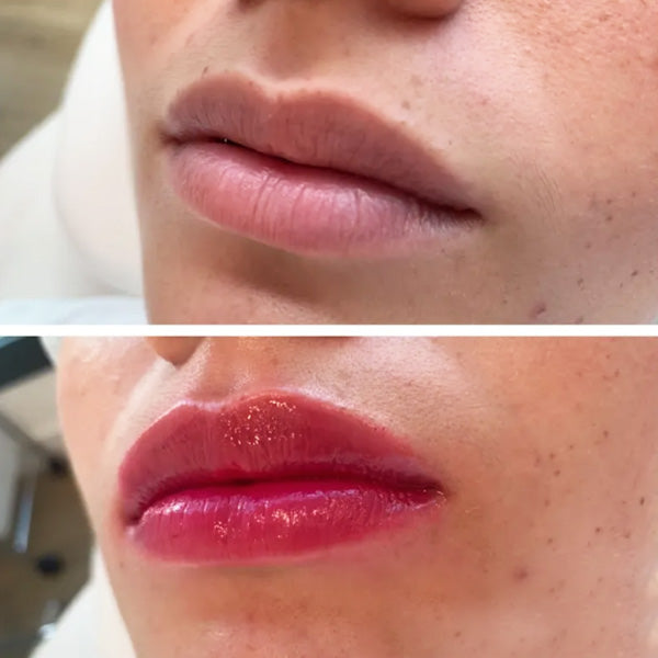 Hidratación de labios, 1 jeringa ácido hialurónico