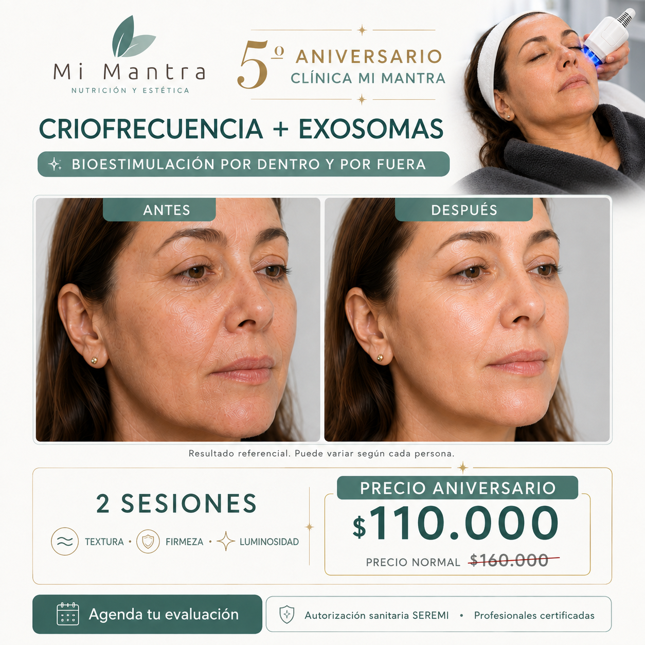 Criofrecuencia + exosomas