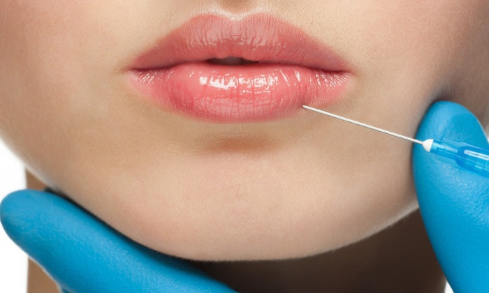 Hidratación de labios, 1 jeringa ácido hialurónico