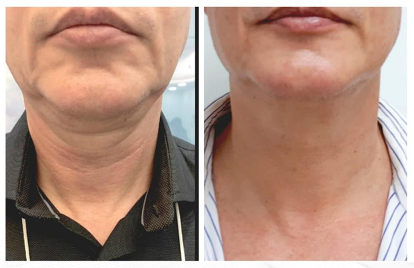 Tratamiento reductivo y lifting papada 5 sesiones