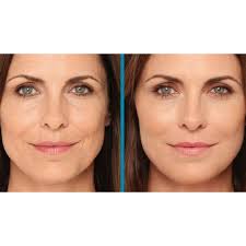 Bioestimulación Hidroxiapatita de calcio